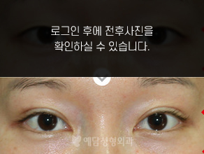 매몰법 쌍꺼풀수술