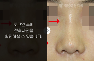 낮은코성형