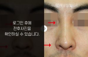 낮은코성형