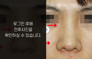 낮은코성형