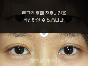 부분절개법 쌍꺼풀수술