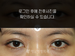 매몰법 쌍꺼풀수술
