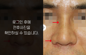 낮은코성형