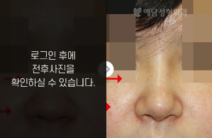 낮은코성형
