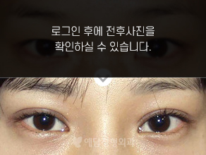 절개법 쌍꺼풀수술