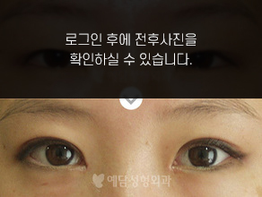 절개법 쌍꺼풀수술+앞트임