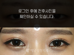 절개법 쌍꺼풀수술+앞트임