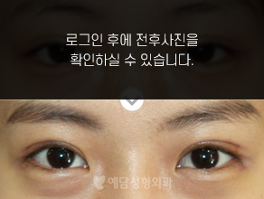 눈재수술