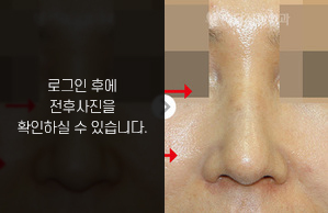 매부리코성형
