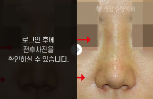 코재수술