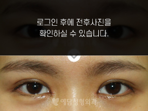 매몰법 쌍꺼풀수술+앞트임
