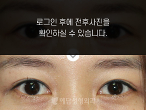 눈재수술