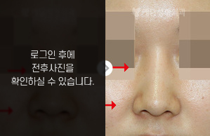 낮은코성형
