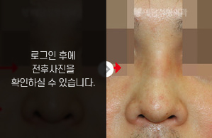 매부리코성형