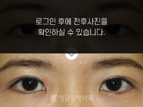 매몰법 쌍꺼풀수술