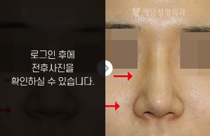 낮은코성형