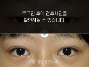 부분절개법 쌍꺼풀수술