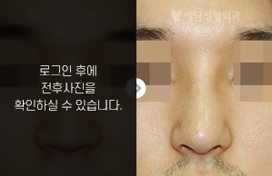 낮은코성형