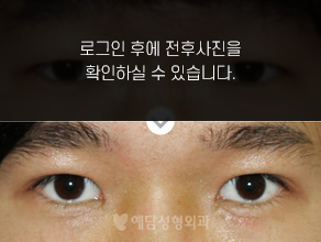 매몰법 쌍꺼풀수술