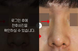 낮은코성형