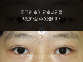 부분절개 쌍꺼풀수술