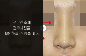 낮은코성형