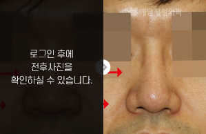 낮은코성형