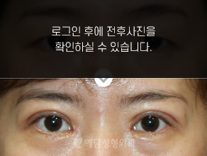 상안검수술