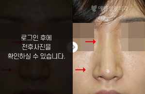매부리코성형
