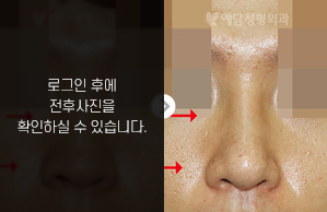 낮은코성형