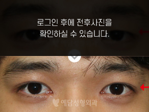 매몰법 쌍꺼풀수술+앞트임