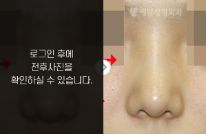 낮은코성형