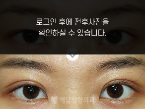 부분절개법 쌍꺼풀수술