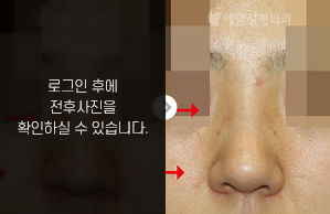 매부리코성형