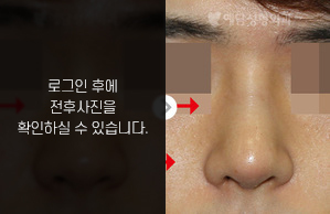 낮은코성형