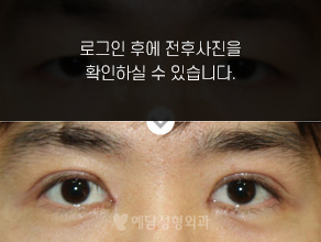 절개법 쌍꺼풀수술+앞트임