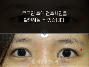절개법 쌍꺼풀수술+앞트임
