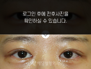 매몰법 쌍꺼풀수술+앞트임