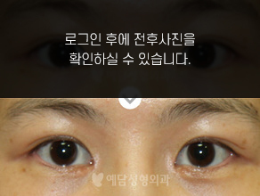 앞트임