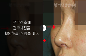 매부리코성형