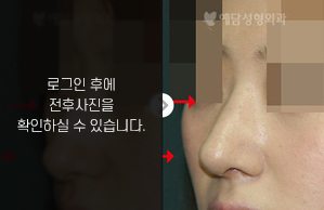 매부리코성형