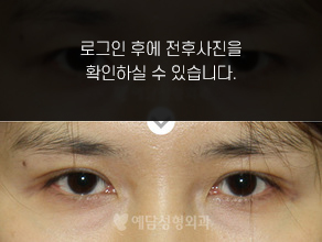 매몰법 쌍꺼풀수술