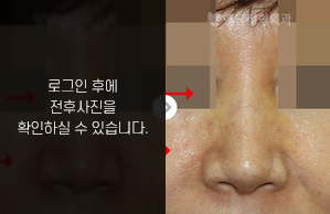 짧은코성형