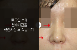 낮은코성형