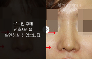 코재수술(보형물 비뚤어짐)