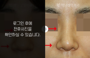 복코성형