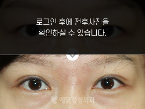 절개법 쌍꺼풀수술