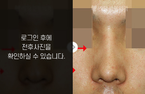 매부리코성형