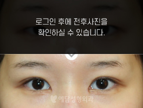 절개법 쌍꺼풀수술+앞트임
