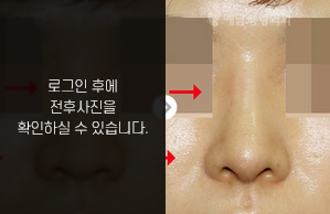 낮은코성형